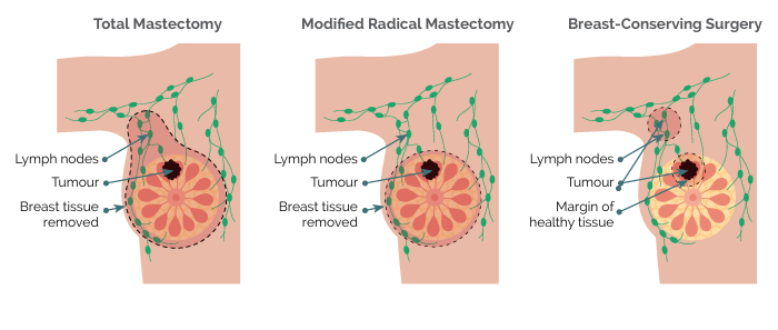 Breast cancer surgery options
